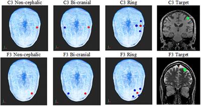 Sex and Electrode Configuration in Transcranial Electrical Stimulation